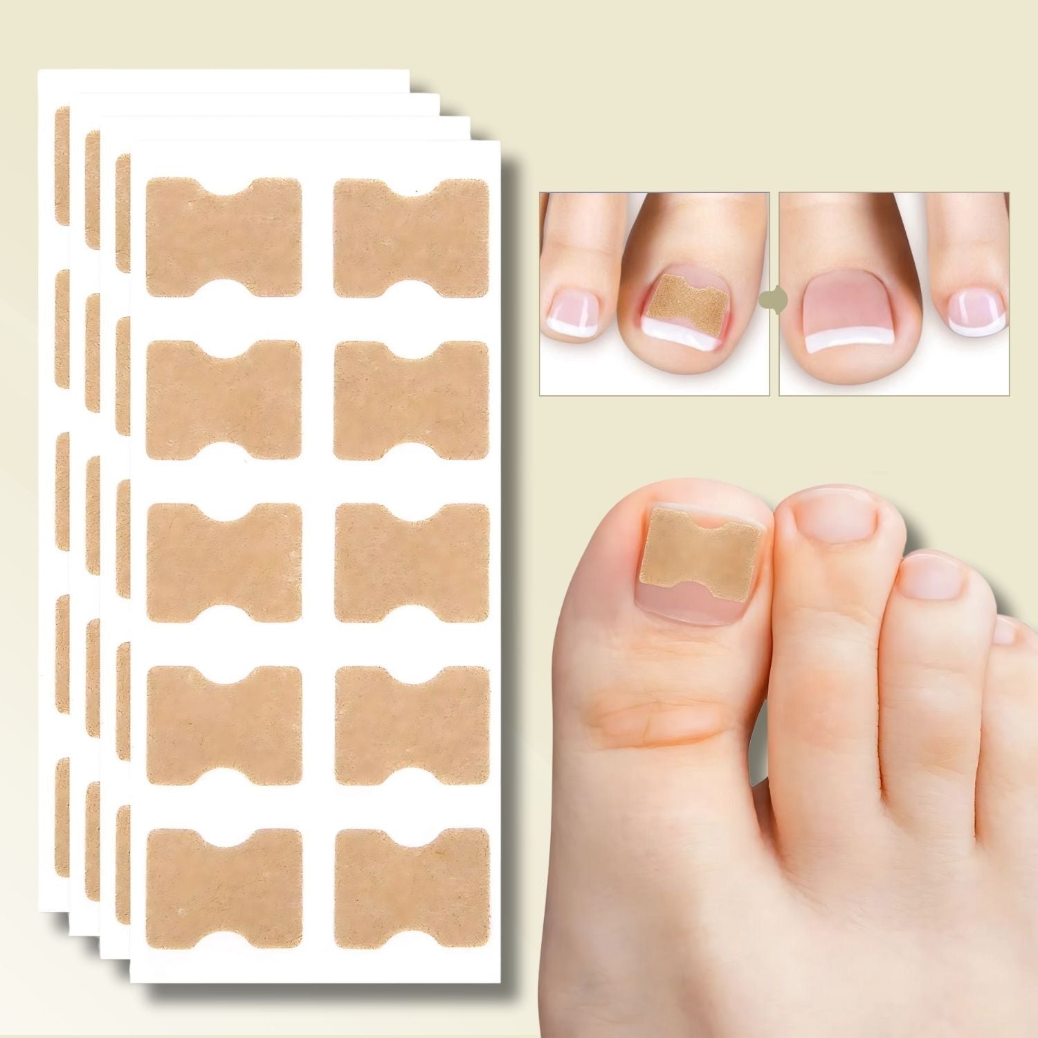Nagelreparationsplåster för inåtväxta naglar 10-pack 0